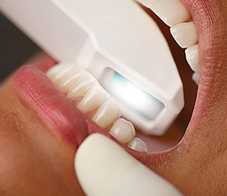 ¿qué Es Un Escáner Intraoral Dentalnova Salud Bucodental Y